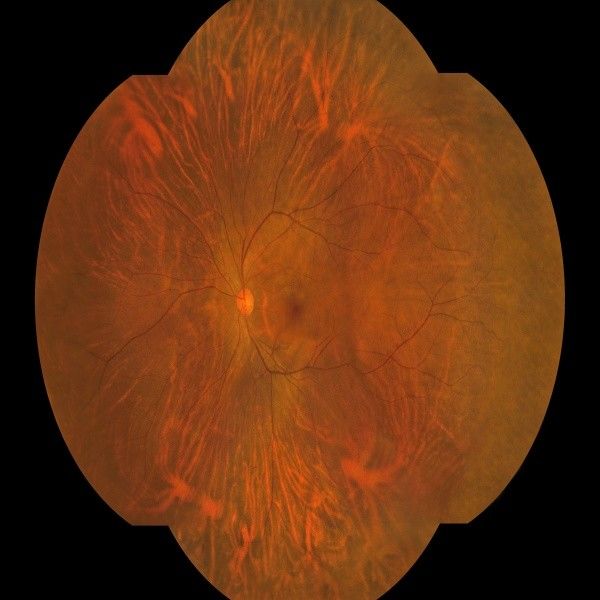 8 мкм оптического разрешения Wide Field Fundus Camera с 27-дюймовым HD цветовым монитором и автоматической фокусировкой